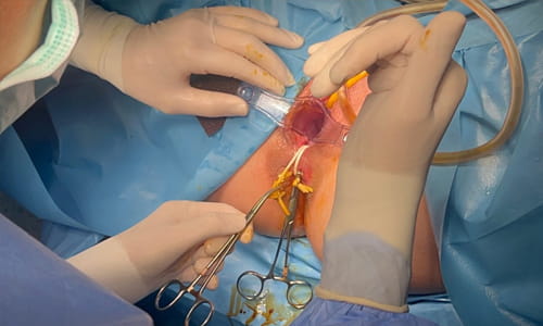 Fistül yoluna seton yerleştirilmesi.