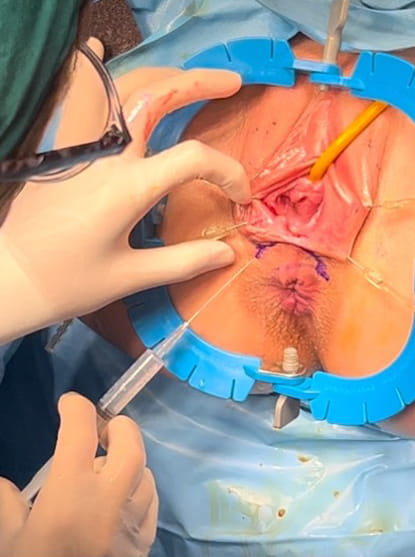 vajen ile rektum arasından yapılan bir kesi ile transperineal onarım tercih edildi.