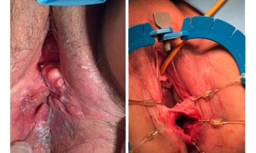 Doğuma Bağlı Anal Sfinkter Yaralanması ve Tedavisi