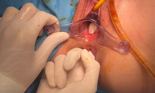 Rektovajinal Fistül Tedavisinde Perineal Onarım