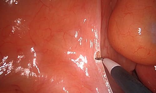 Rektum Kanseri Olan Her Hasta Ameliyat Öncesi Tedavi Almak Zorunda Mıdır?