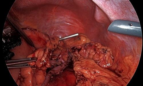 Pankreas Nöroendokrin Tümöründe Laparoskopik Subtotal Dalak Koruyucu Pankreatektomi