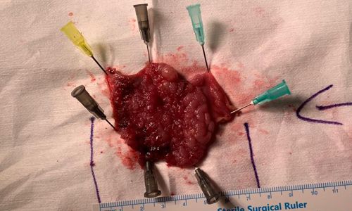 Transanal Minimal İnvaziv Cerrahi (TAMİS) Yöntemi