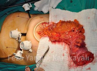 Laparoskopik Cerrahi Ameliyatı