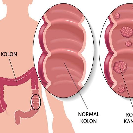 Kolorektal Kanser Belirti Ve Bulgular