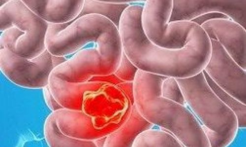 ما هي عوامل الخطر لسرطان القولون والمستقيم؟