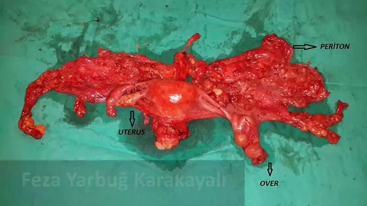 Periton kanserinde sitoredüksiyon amaçlı yapılan çoklu organ rezeksiyonları